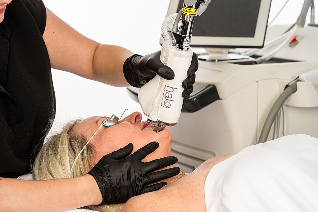 Woman receiving laser treatment for skin rejuvenation.