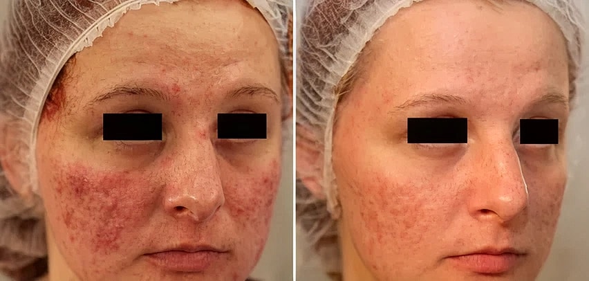 Before and after skin treatment comparison.