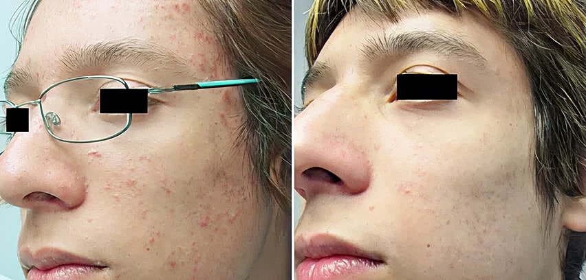 Before and after skincare treatment results.