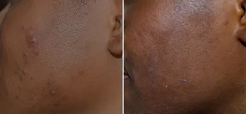 Comparison of skin texture before and after treatment.