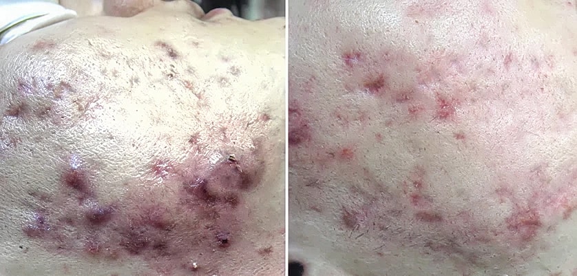 Severe acne before and after treatment comparison.