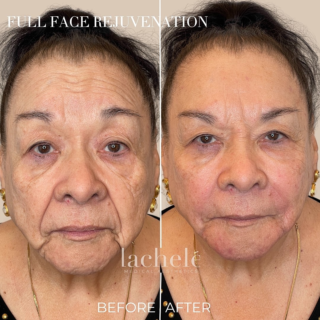 Before and after face rejuvenation treatment results.