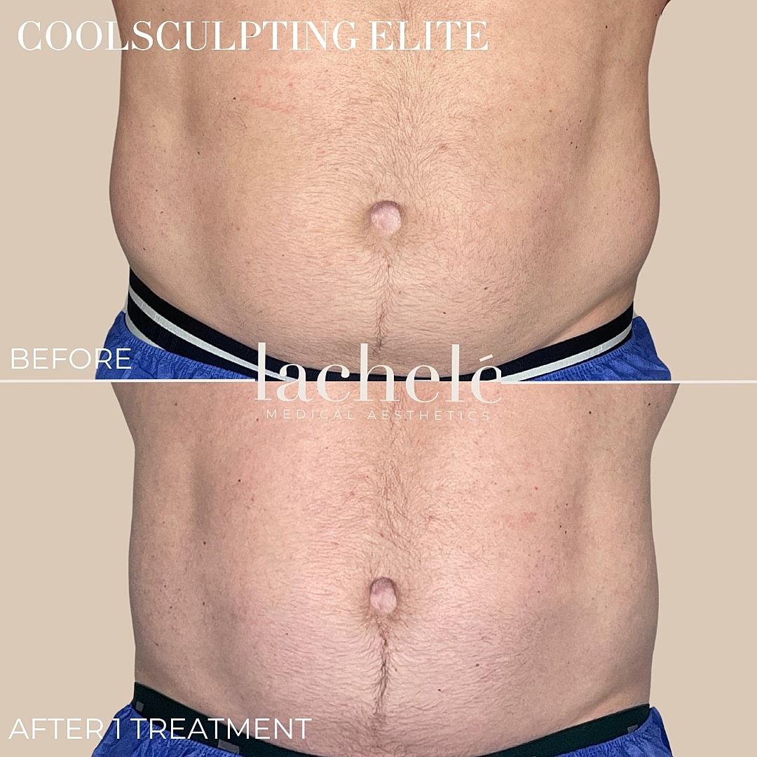 CoolSculpting Elite before and after comparison
