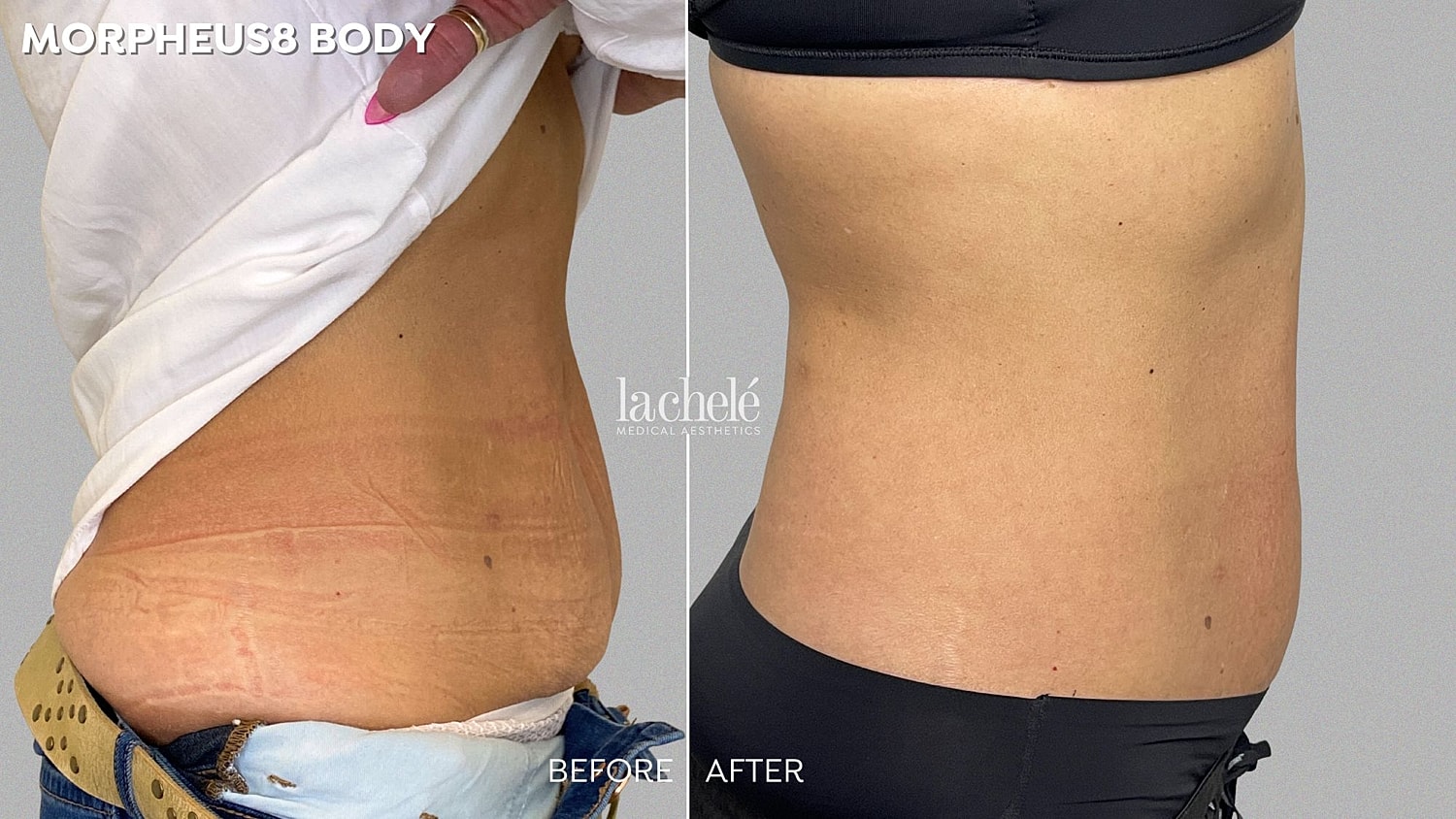 Body contouring transformation before and after.