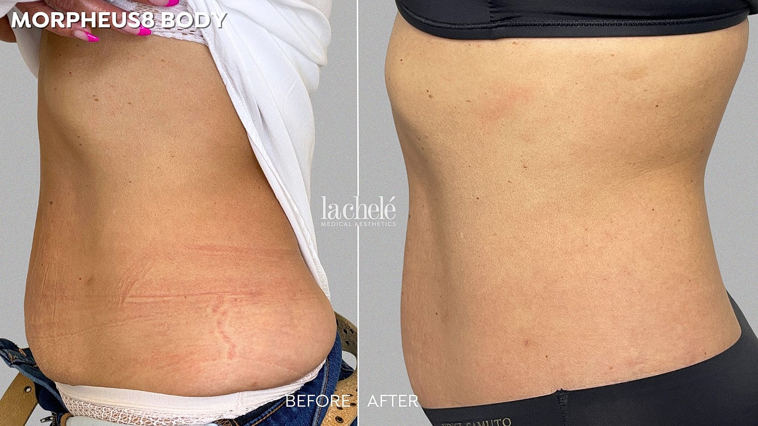Morpheus8 body treatment before and after results.