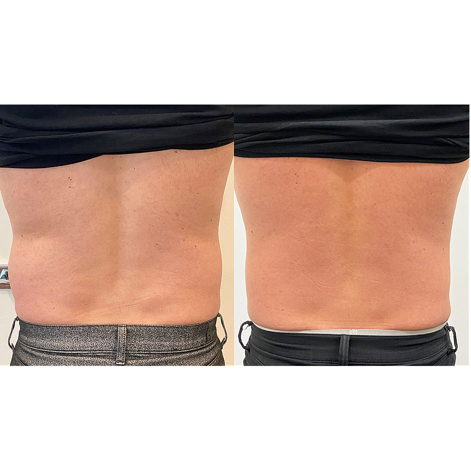 Comparison of two bare backs, different appearances.