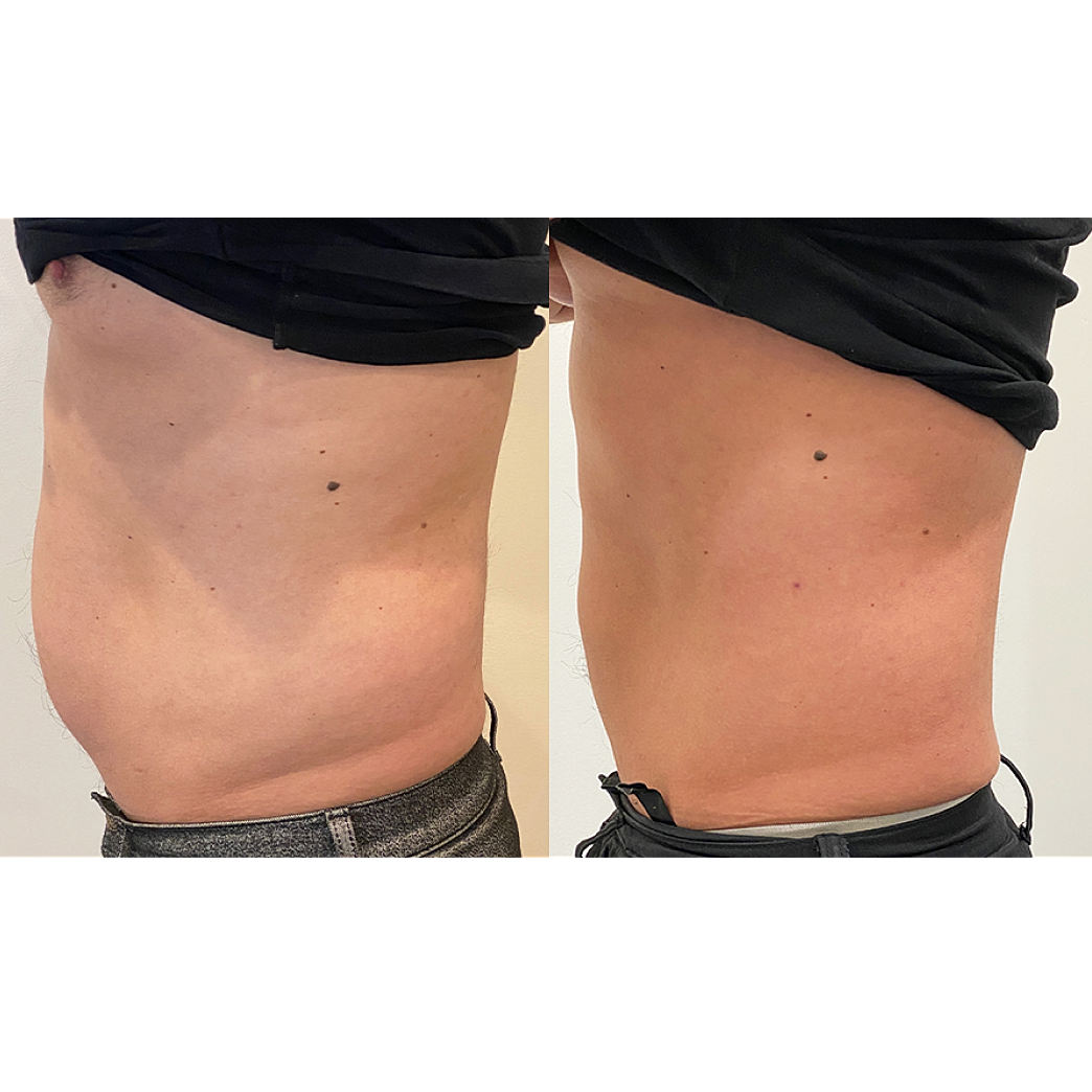 Before and after body transformation comparison.