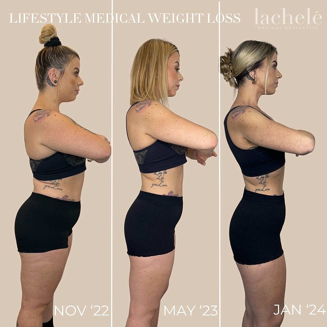 ozempic before and after