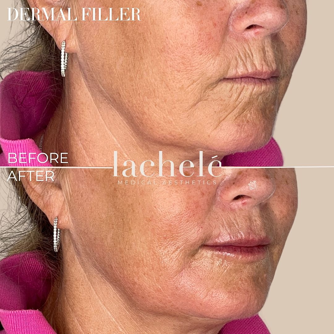 Dermal filler results: before and after comparison.