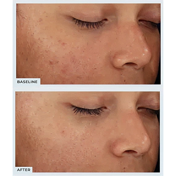 Skin improvement before and after treatment.