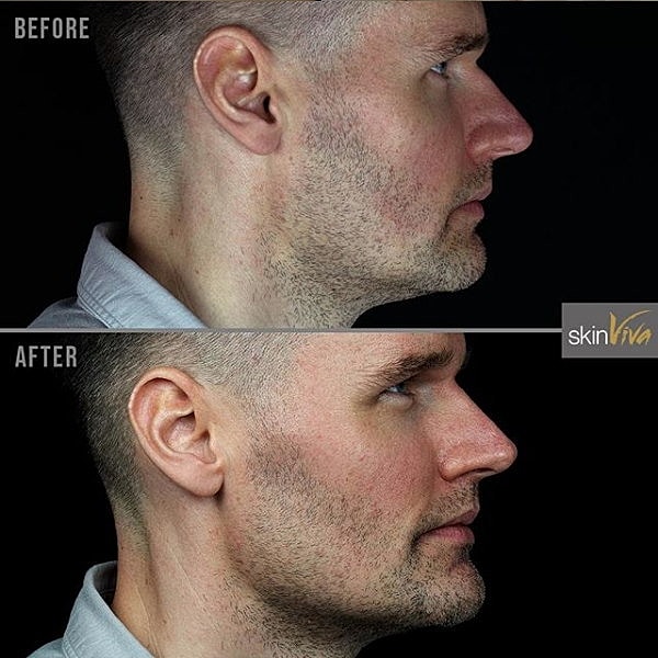 Before and after facial profile transformation.