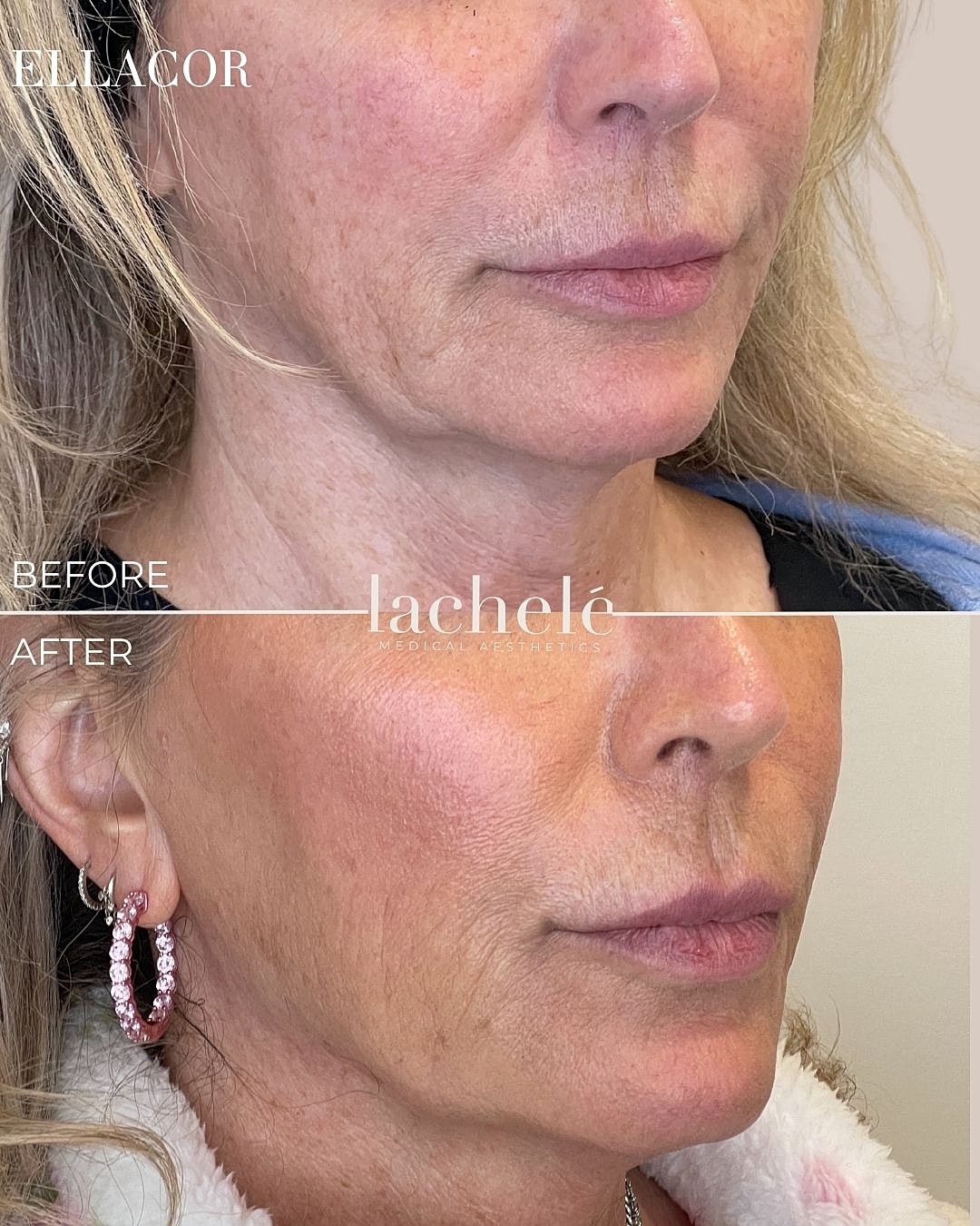 Before and after aesthetic treatment comparison.