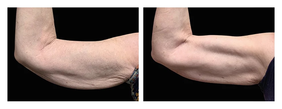 Before and after arm strength comparison