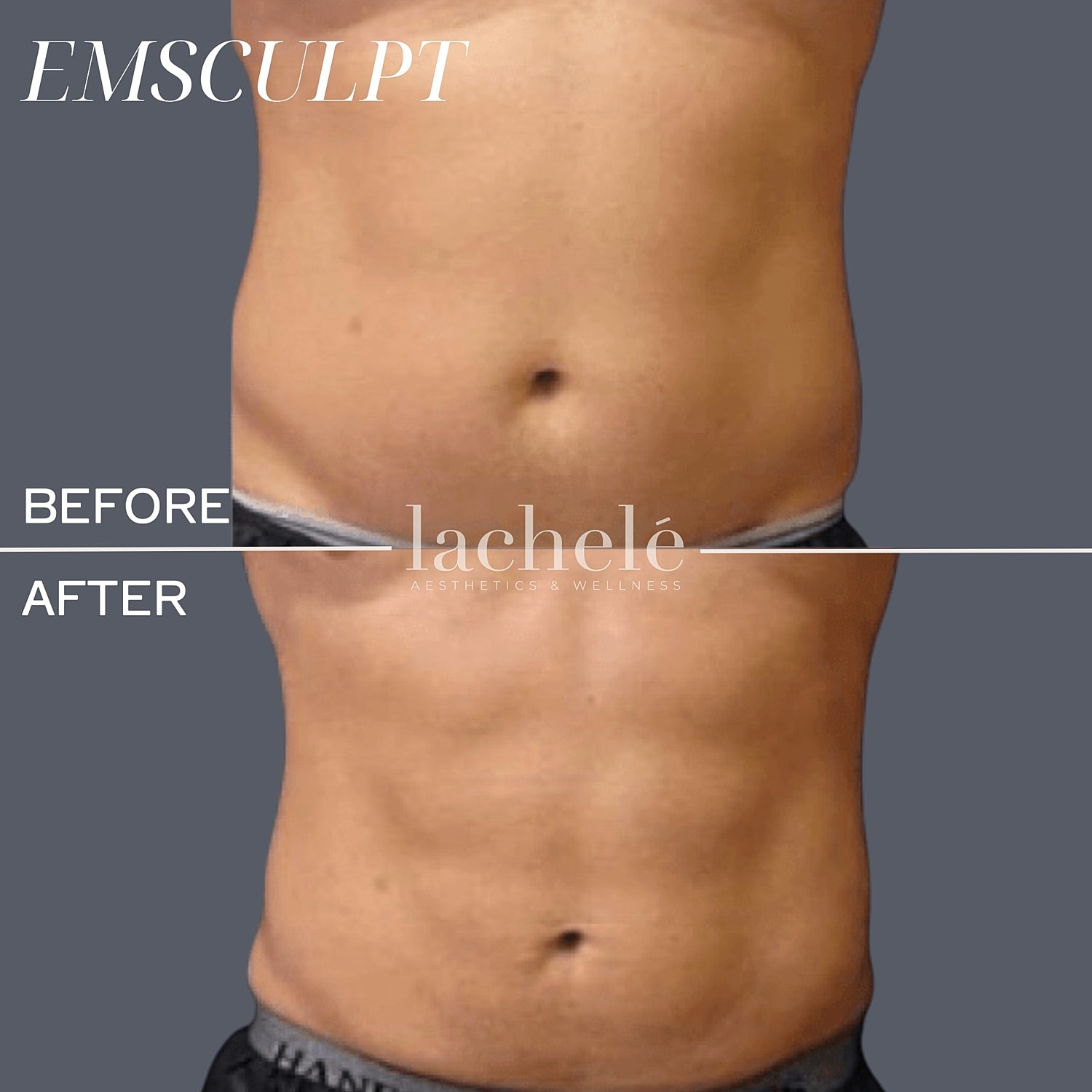 Emsculpt before and after body transformation.