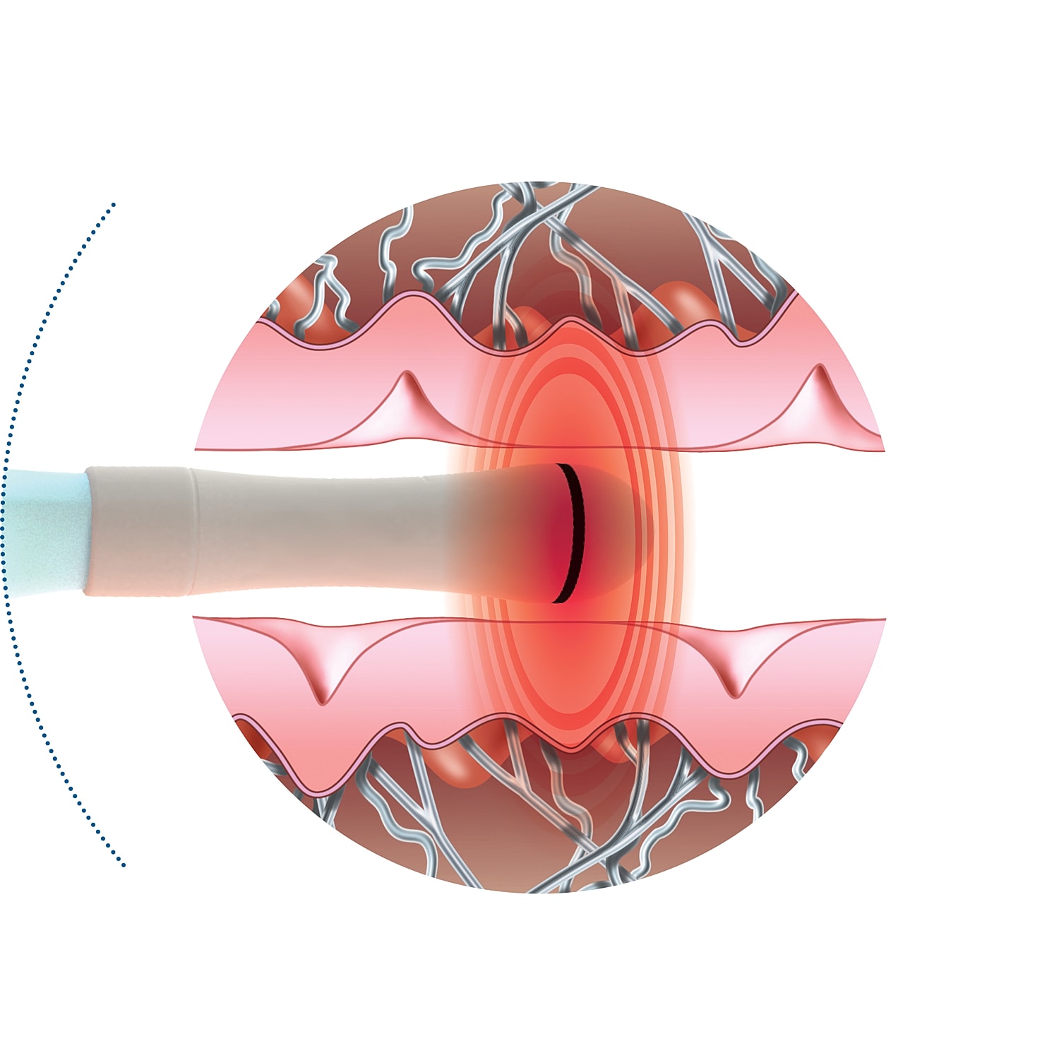 Skin treatment technology illustration with catheter.