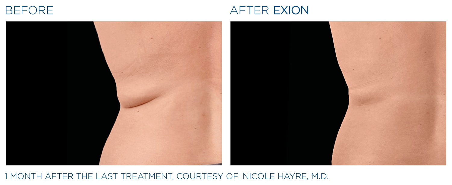 Before and after Exion body treatment comparison.