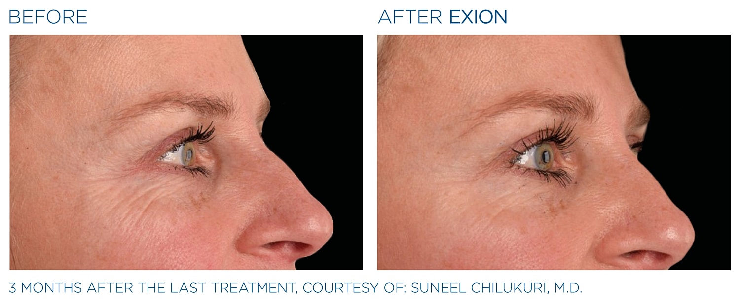Before and after Exion treatment results comparison.
