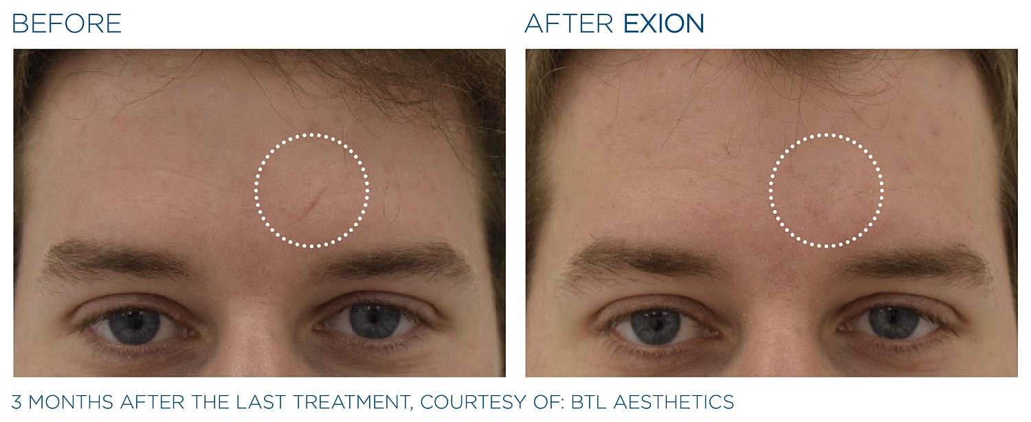 Before and after skin treatment results comparison.