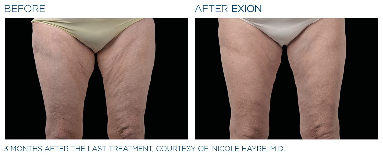 Leg transformation before and after Exion treatment