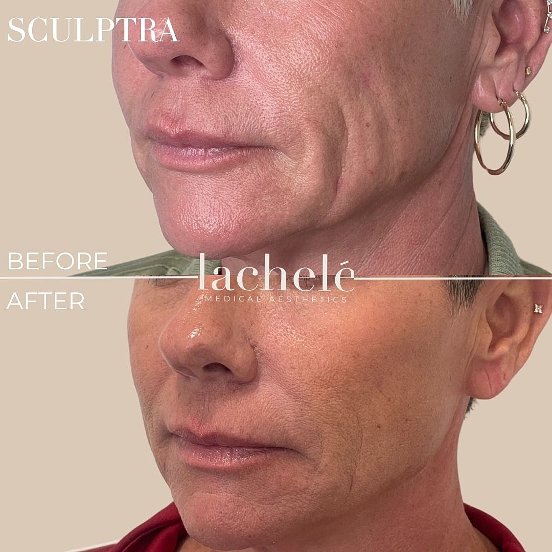 Sculptra results: before and after comparison.