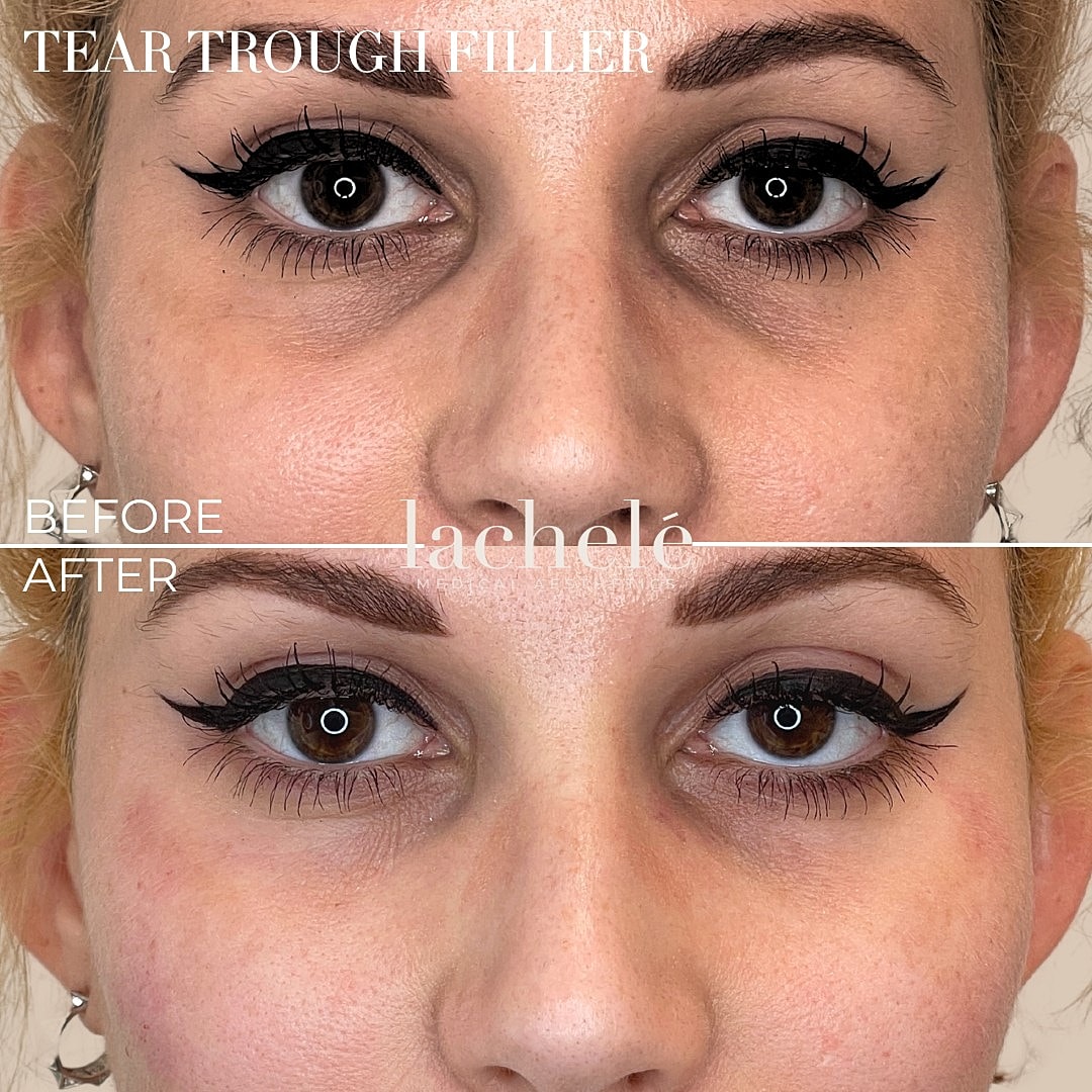 Before and after tear trough filler treatment.