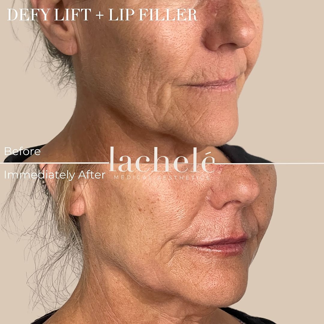 Before and after lip filler treatment results.
