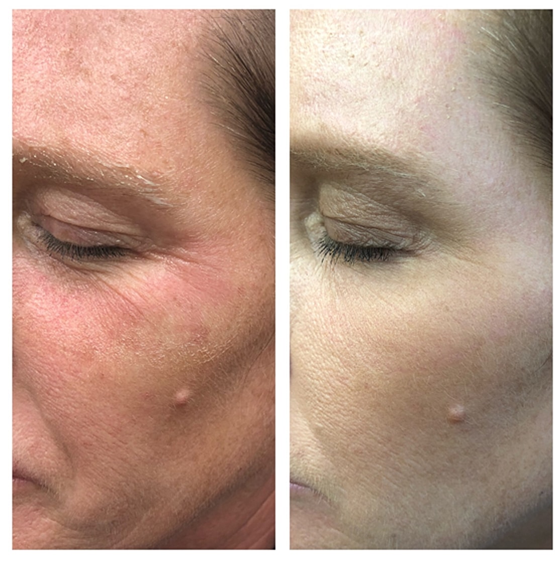 Before and after skin treatment comparison photo.