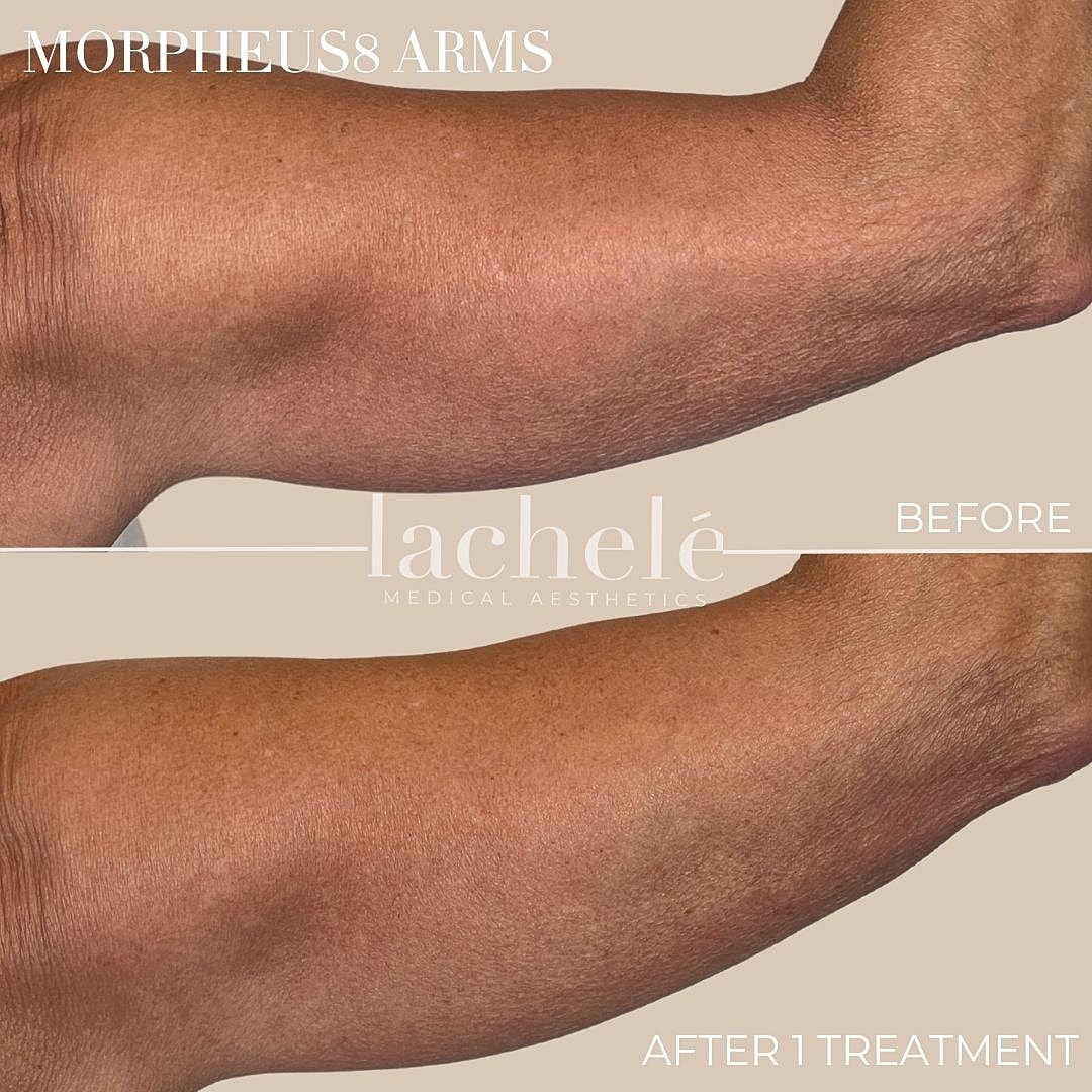 Morpheus8 treatment results for arm skin.