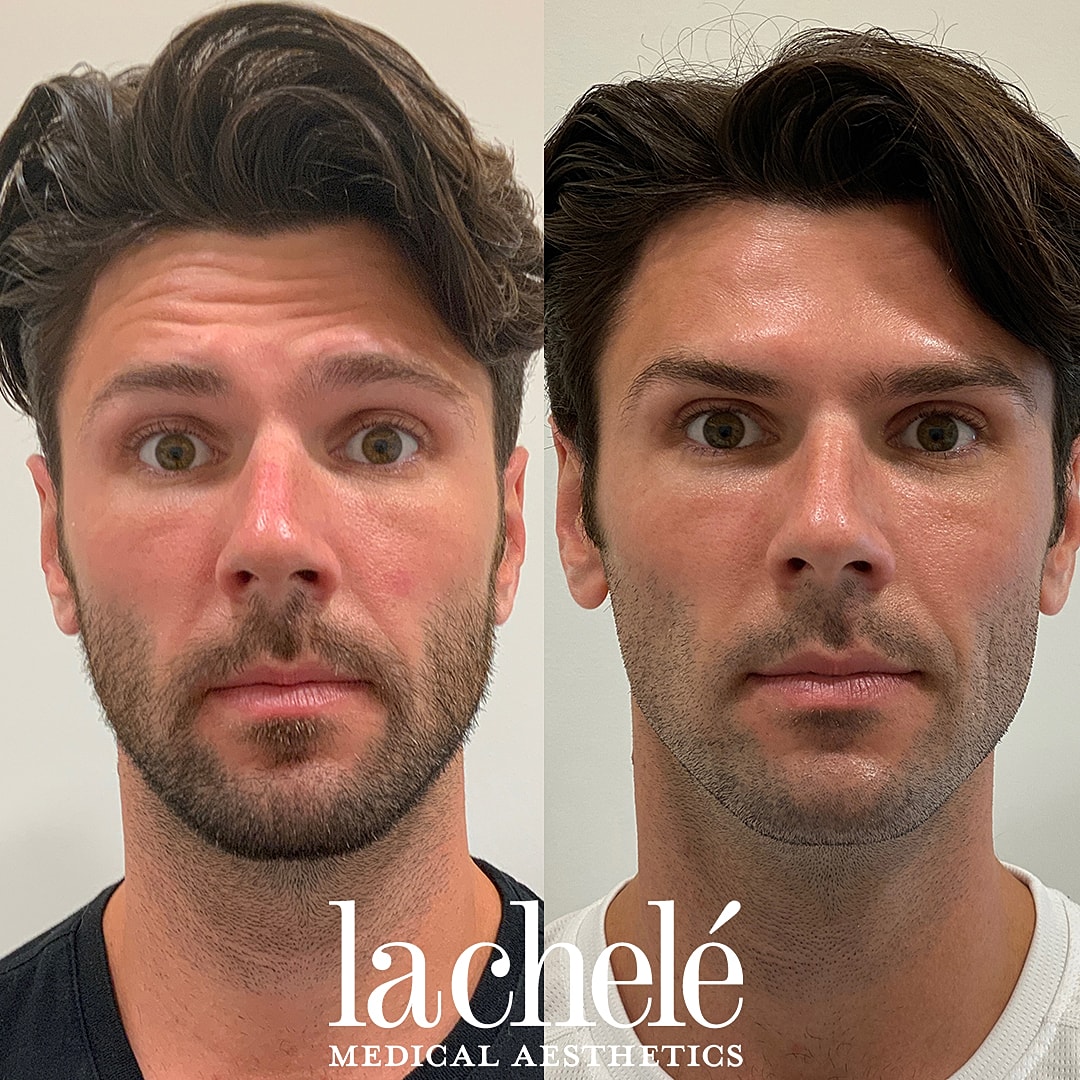 Before and after aesthetic treatment comparison.