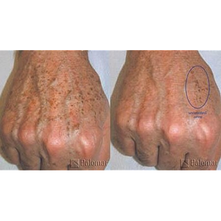 Sun damage on hands before and after treatment.