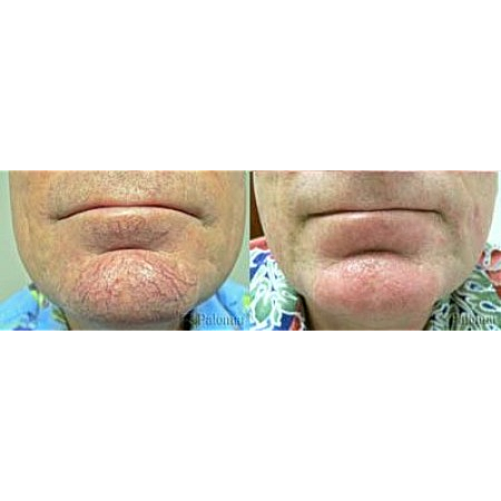 Before and after skin treatment comparison.