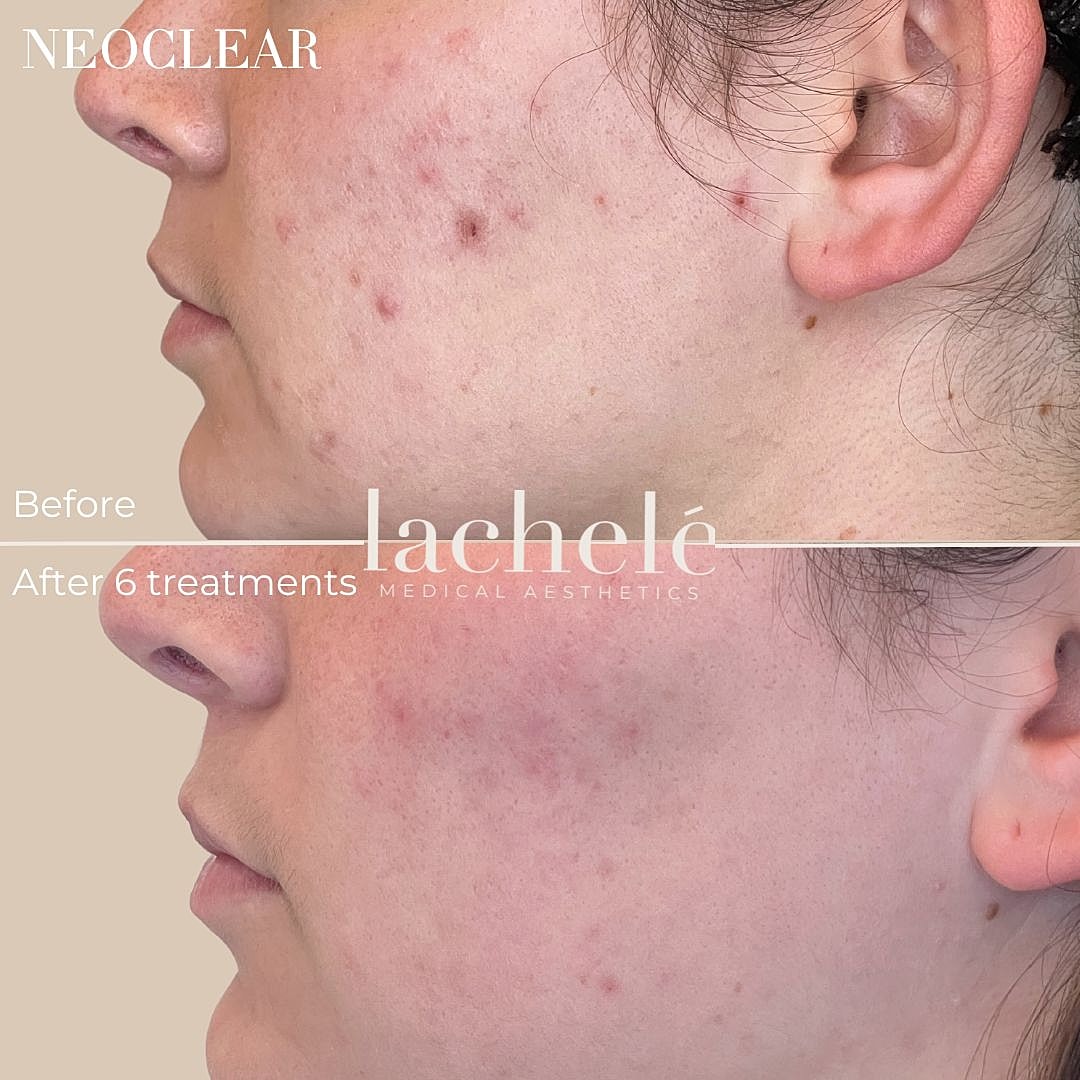 Skin improvement after six treatments comparison.
