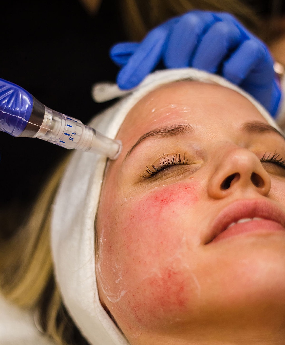 Microneedling treatment for facial rejuvenation.