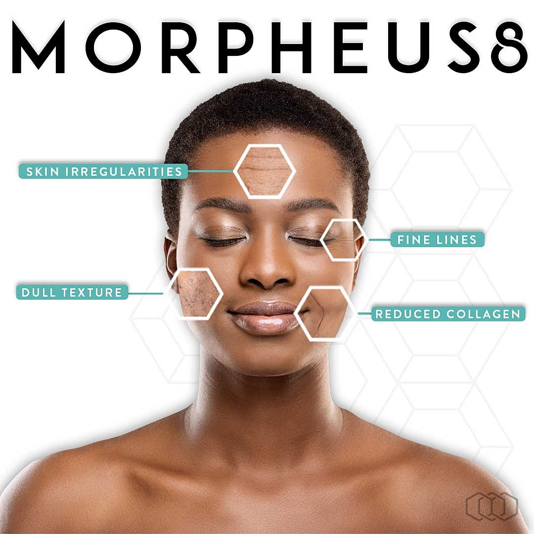 Morpheus8 skin treatment benefits and concerns illustrated.