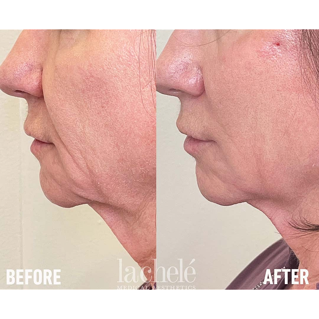 Before and after photos of facial treatment.