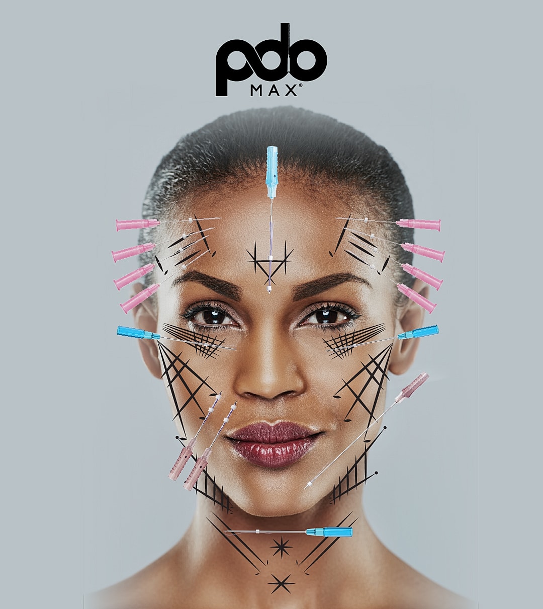 Cosmetic treatment with PDO threads and markings