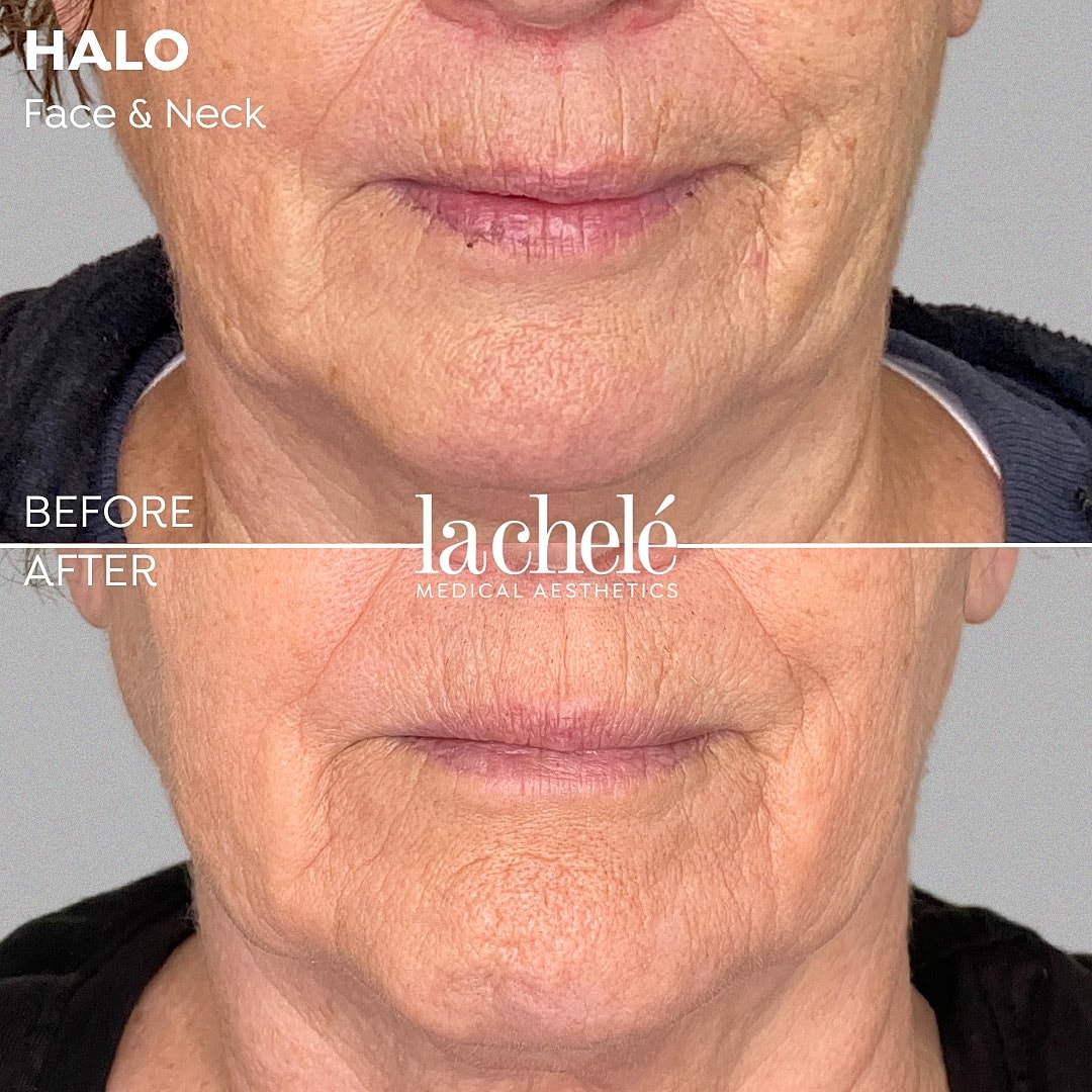 Face and neck treatment before and after results.