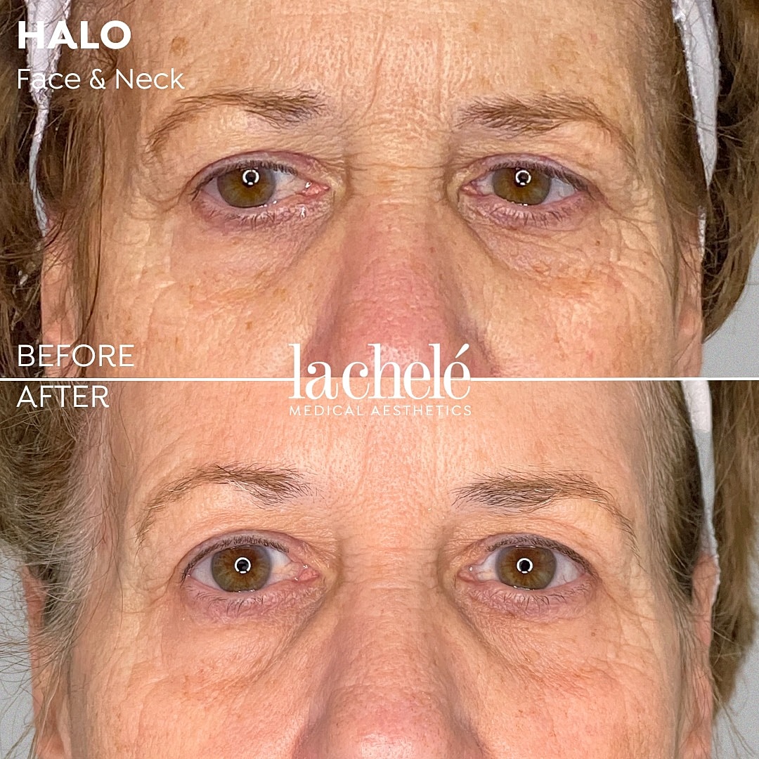 Face and neck treatment before and after results