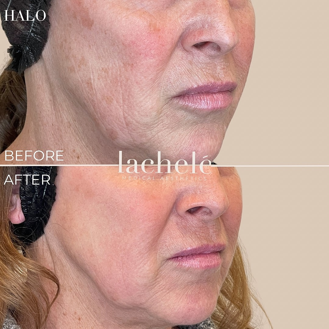 Before and after skin treatment comparison photo.