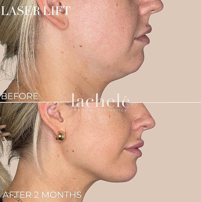 Laser lift transformation before and after two months.