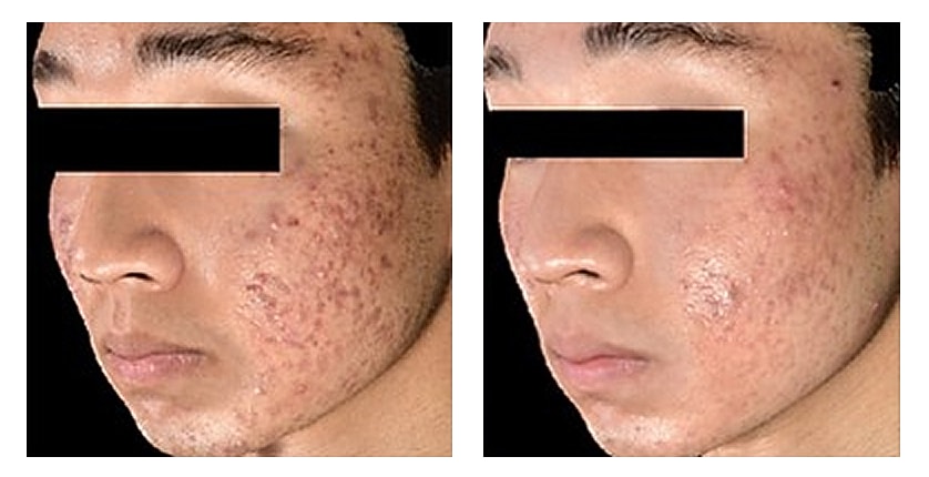Before and after skin treatment comparison.