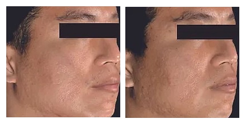 Profile comparison of a person's face.