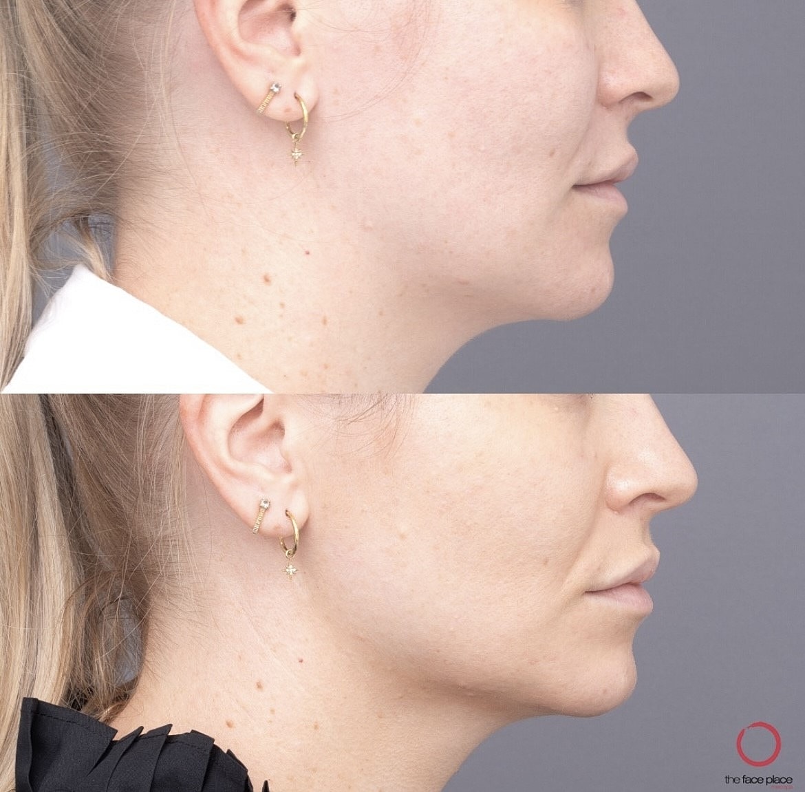 Before and after side profile comparison of woman.