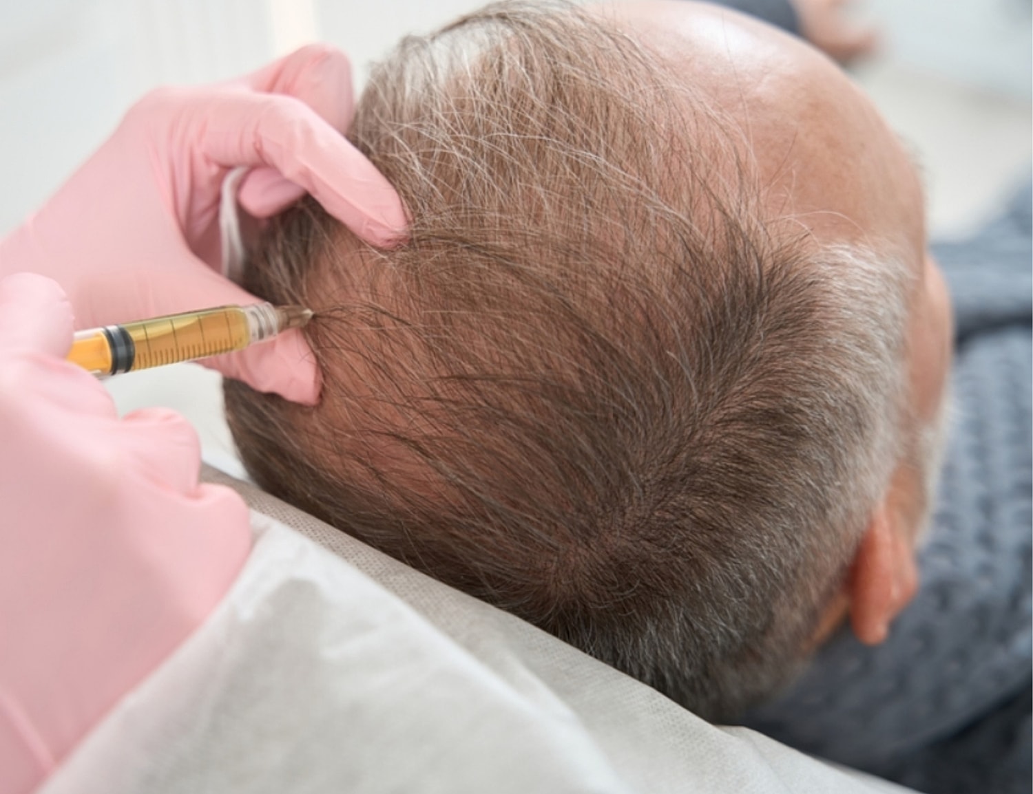 Hair restoration treatment using injection on scalp.
