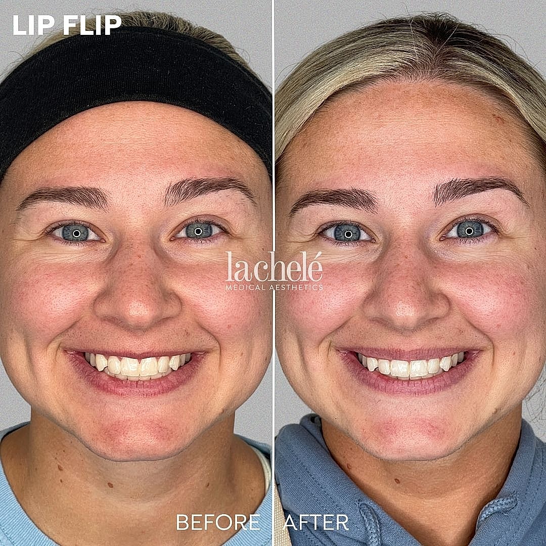 Lip flip before and after transformation image.