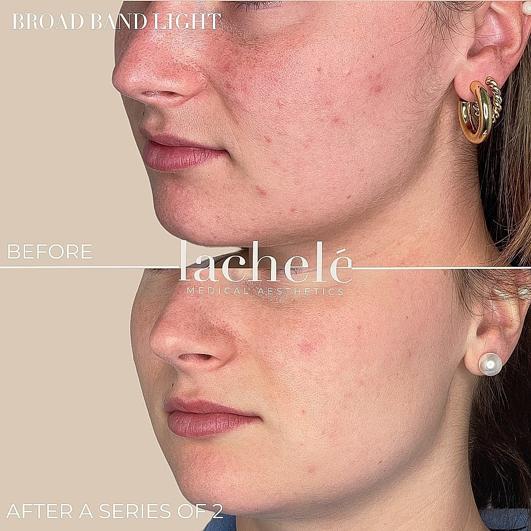 Before and after skin treatment comparison photo.