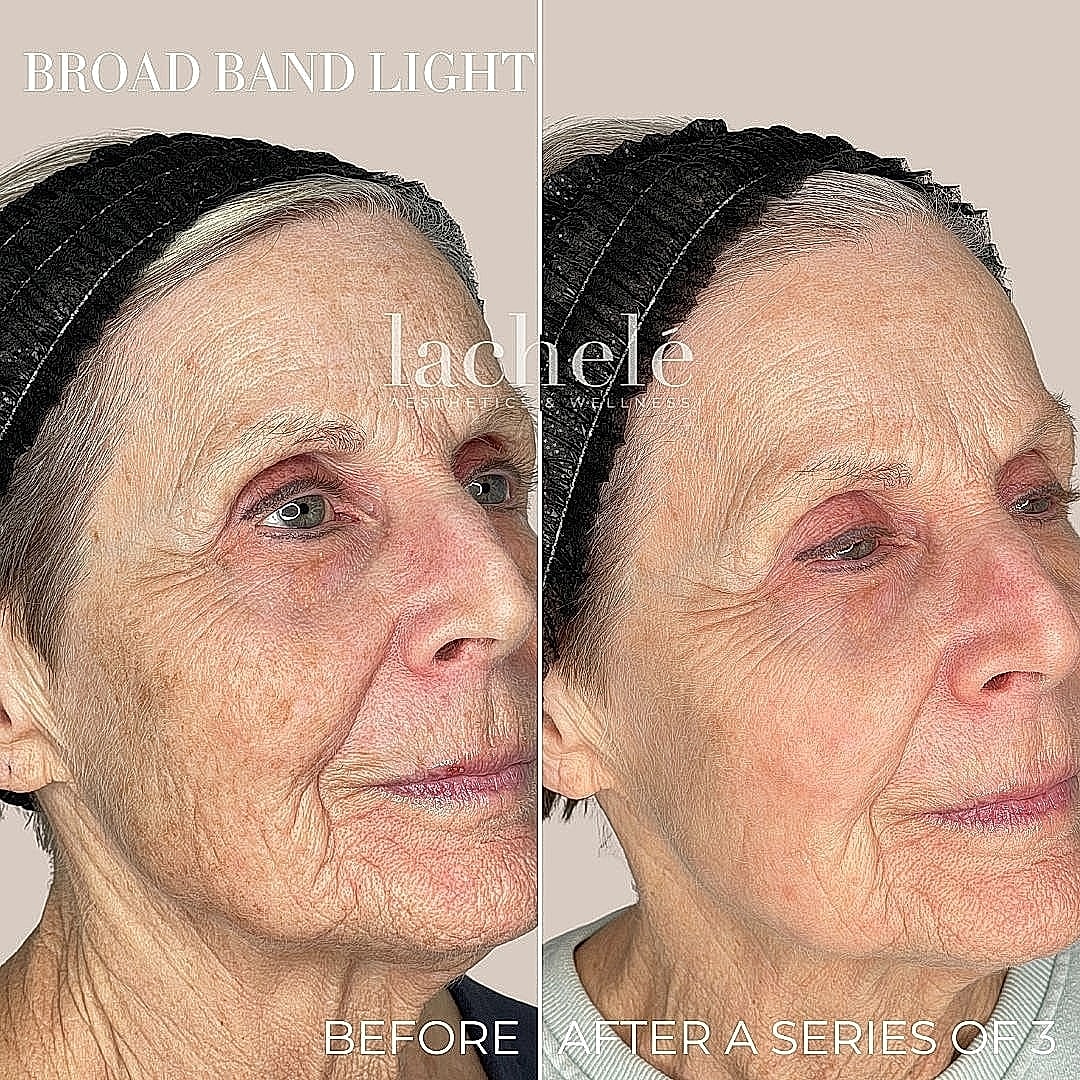 Before and after broadband light treatment results