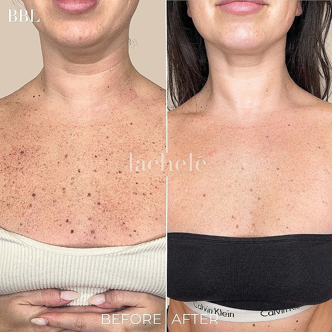 BBL skin treatment before and after comparison
