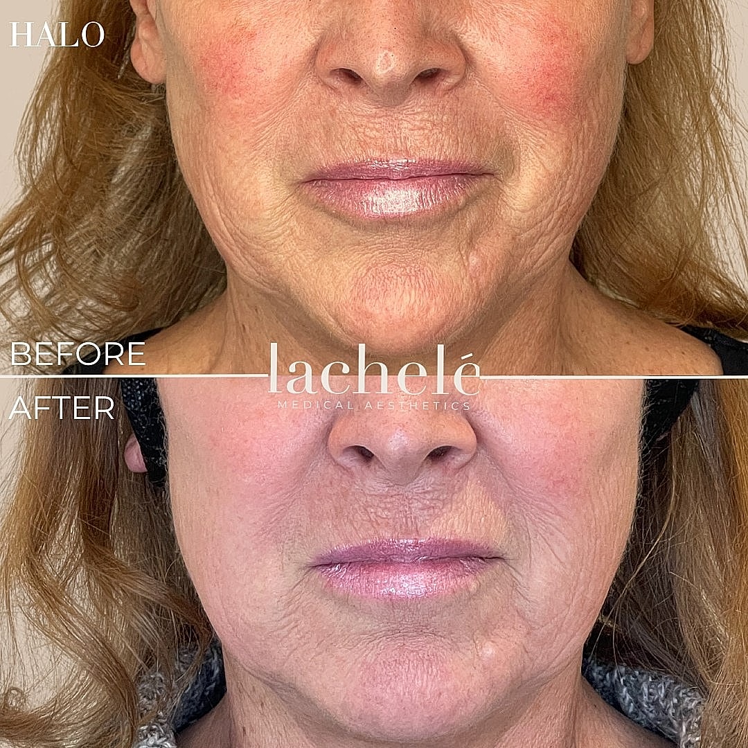 Before and after aesthetic treatment comparison.