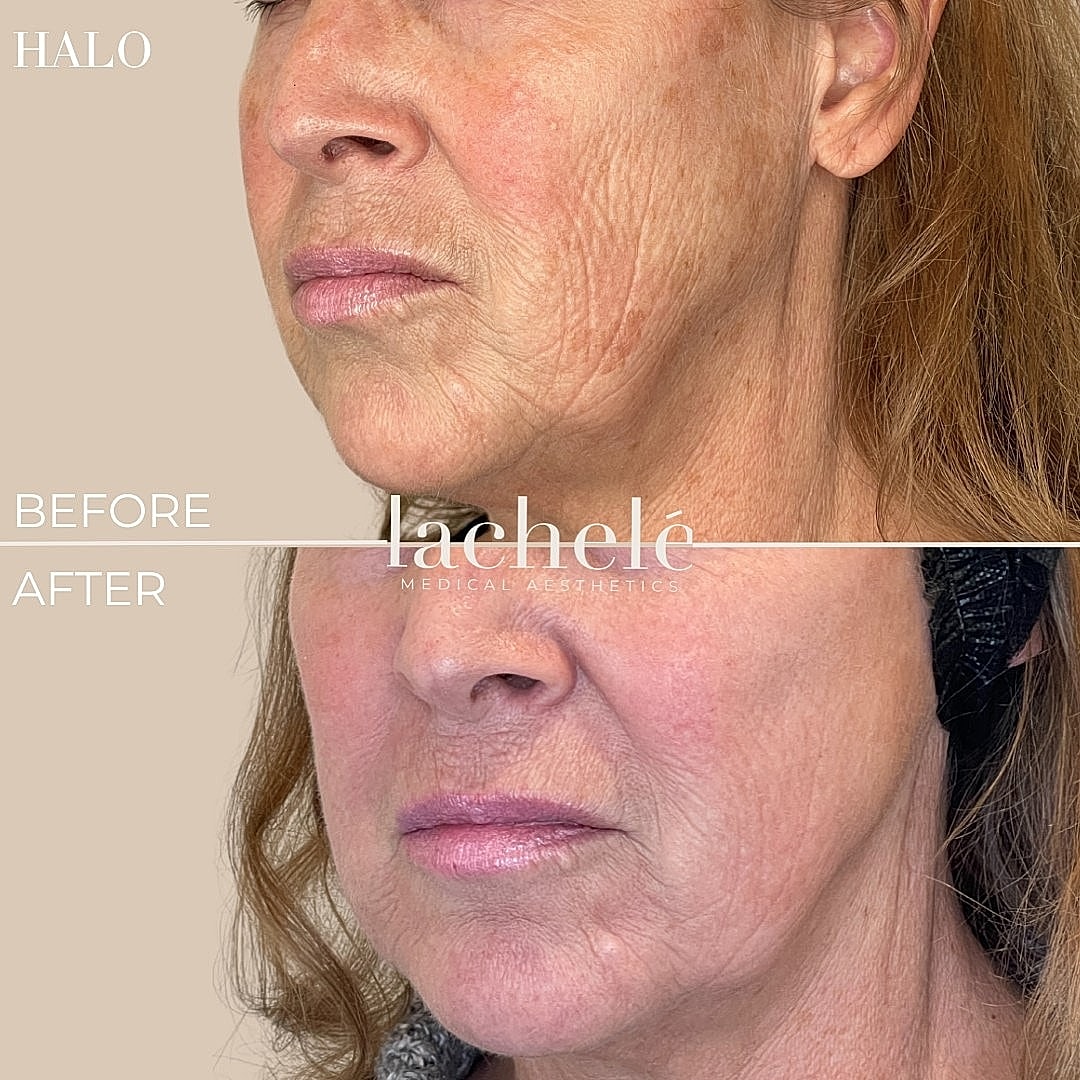 Before and after skin treatment comparison.